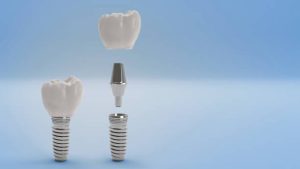 dental implants expert Adelaide